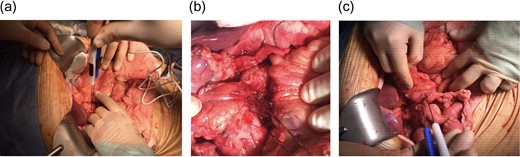 Intraoperative irreversible electroporation (IRE) margin accentuation using one pair of probes. The technique included probe placement using three different approaches including the anteroposterior (a), the caudo-cephalad between the superior mesenteric artery (SMA) and vein (SMV) (b) and the transduodenal (c) in order to augment the pancreatic, the SMV/ SMA groove and the posterior margins.