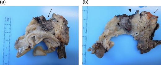 (a and b) Pancreaticoduodenectomy specimen sliced in an axial plane, according to the Leeds Pathology Protocol, providing good visualization of the tumour and its relationship to key anatomical structures and the anterior, posterior and superior mesenteric vein groove surfaces. (a) Demonstrates an area of haemorrhage/necrosis due to IRE needles extending to the SMV bed (arrow) and (b) shows the SMV (arrrowhead) and the SMA groove (arrow).