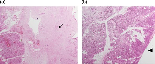 (a and b) Histopathology using haematoxylin and eosin stain showing extensive area of necrosis (arrow) without any viable tumour at the SMV bed (arrowhead).
