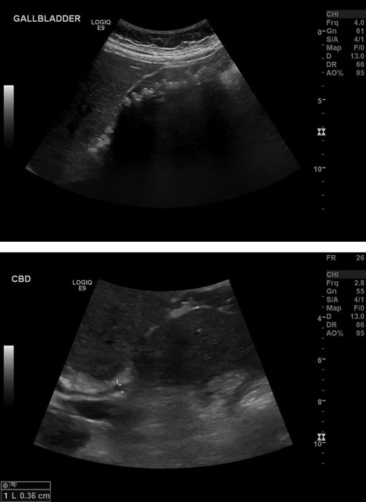 Extensive number of shadowing gallstones in the gallbladder. Negative for thickening of the anterior gallbladder wall. Negative for intra or extra-hepatic biliary dilatation.