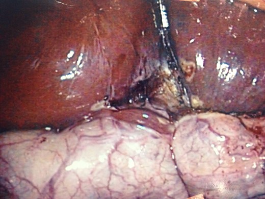 Intraoperative photo displaying gallbladder reflected superiorly, liver inferiorly and small nodule of normal liver parenchyma adherent to the gallbladder.