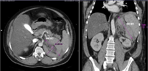 Case 1 presenting imaging (CT) showing a large left peri-adrenal hematoma.