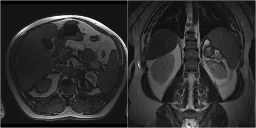 Case 1 follow-up MRI showing almost complete resolution of the hematoma and absence of underlying adrenal lesion.