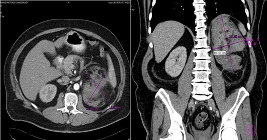 Case 2 presenting imaging (CT) showing a large left peri-adrenal hematoma.