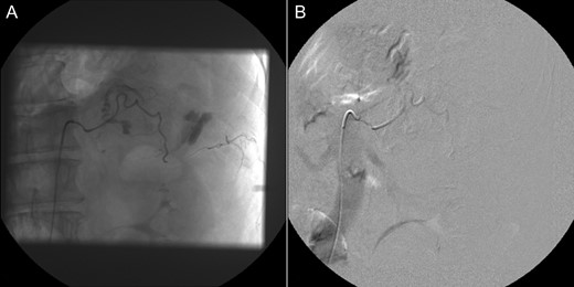 Selective adrenal artery angiography showing active extravasation from the middle adrenal artery (A) and subsequent successful embolization (B).