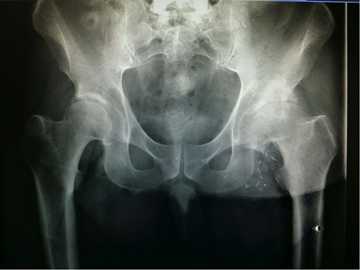 Pre-operative AP pelvis radiograph.