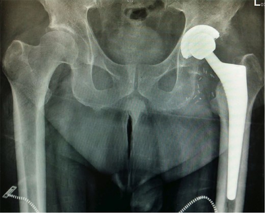 Post-operative AP pelvis radiograph.