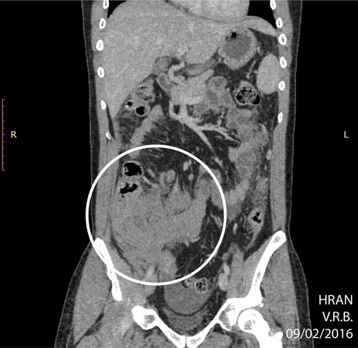 CT of abdomen (coronal plane) highlighting an extensive, ill-defined mass localized in the right iliac fossa (circle) (02/09/16).