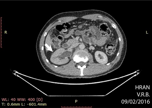Axial CT showing hydronephrosis by compression of the tumor (arrow) (02/09/16).