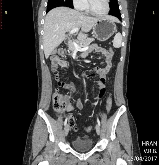 PET CT of abdomen showing regression of the abdominal mass (04/05/2017).