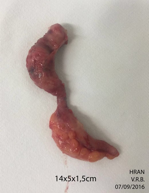 The surgical specimen. Macroscopy: thickened wall and congested appendix.