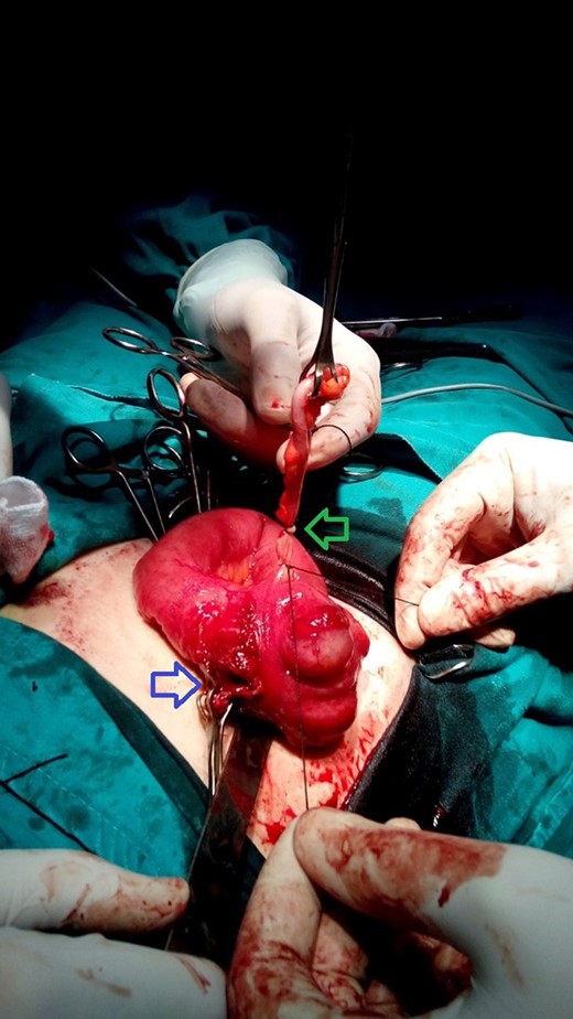 A photograph taken during surgery. Blue arrow indicates the site of inflamed appendix after resection. Green arrow indicates the second appendix.