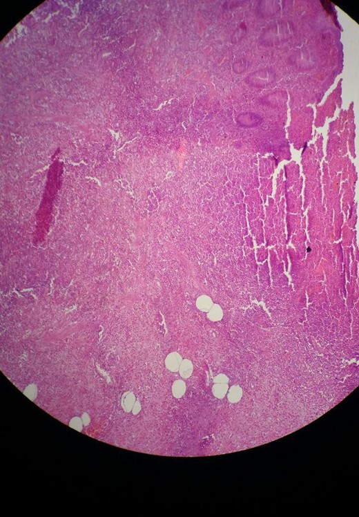 Microscopic view of the first specimen with acute appendicitis. Sections show focal ulceration of the mucosa and acute inflammatory infiltrate (mainly neutrophils) throughout the wall.