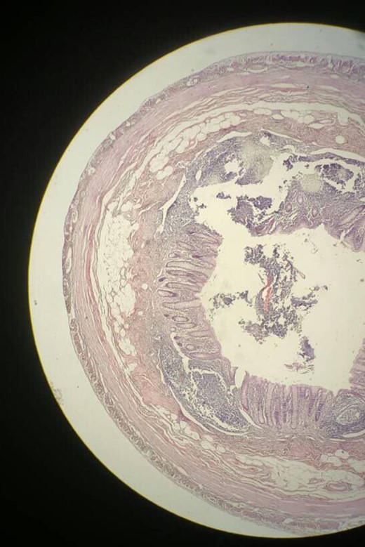Microscopic view of the second specimen with a nearly normal appendix. Sections show a thin walled appendix lined by a colonic type glandular epithelium.