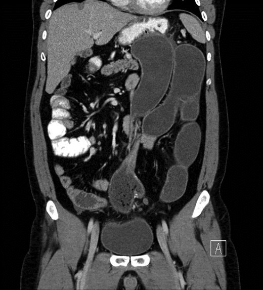 CT concerning for volvulus of small bowel proximal to pouch with proximal distended bowel.