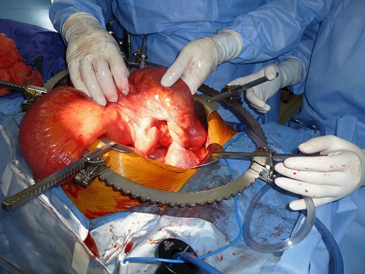 Intraoperative findings of ‘twist’ in the small bowel proximal to the pouch.
