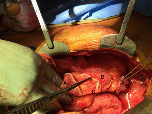 Novel repair option: small bowel proximal to the pouch was transected and subsequently resected. Figure shows disconnected small bowel proximally and distally. (A) proximal small bowel; (B) distal pouch; (C) mesentery feeding the pouch; and (D) portion of the small bowel to be resected.