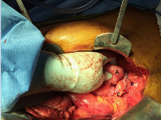 Small bowel has been resected. End to end anastomosis will be made from Point (A) to Point (B). Mesentery (C) is left ‘twisted’ behind the new anastomosis but blood supply to pouch maintained.