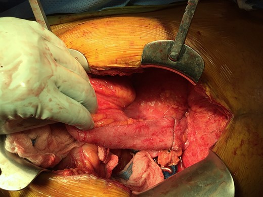 End to end anastomosis created with 28″ EEA stapler.