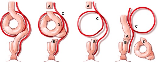 Schematic illustrating our repair: (A) proximal bowel, (B) distal pouch, (C) unresected, twisted blood supply/mesentery; and (D) resected small bowel.