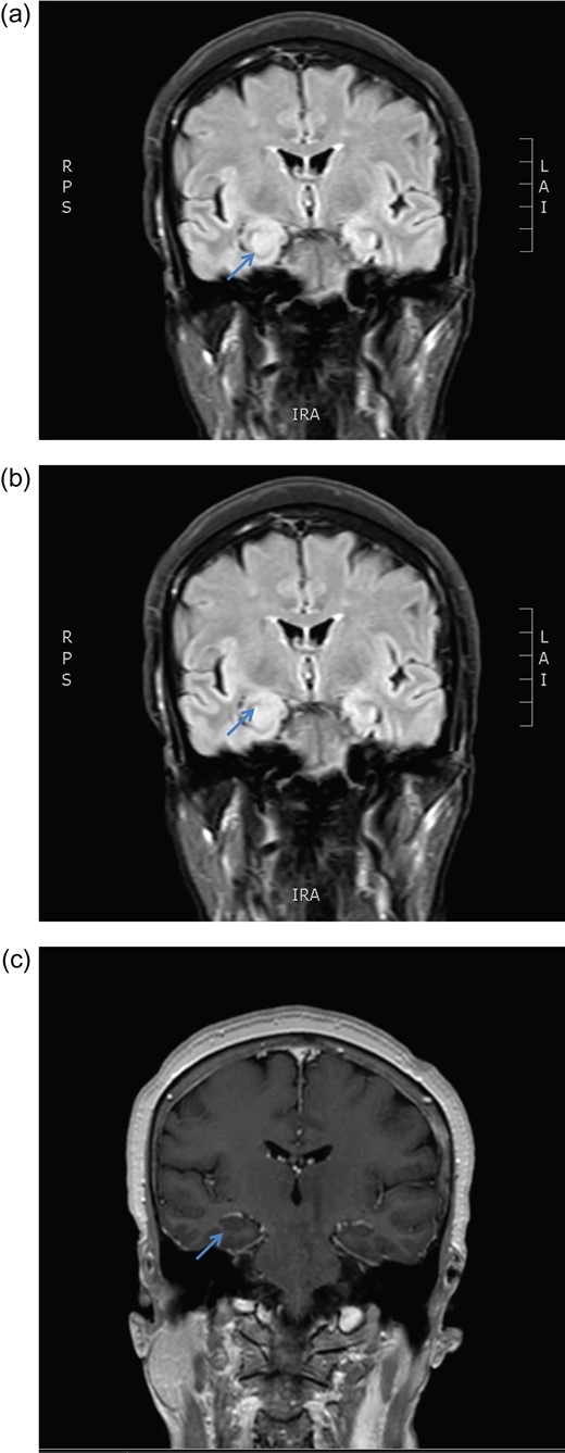 MRI brain coronal T2 FLAIR sequence depicting persistent right hippocampal high signal change in January (a) and March (b) 2016. There is no enhancement post gadolinium injection (c).