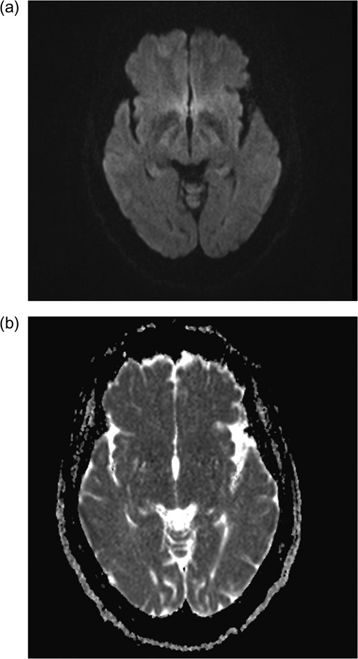 Axial MRI brain (a) diffusion weighted imaging (DWI) and (b) apparent diffusion coefficient (ADC) demonstrating no restricted diffusion.