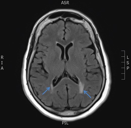 MRI brain axial T2 FLAIR sequence (October 2016) depicting resolution of right medial temporal lobe high signal but prominence of periventricular hyperintensity in periventricular white matter (arrows).