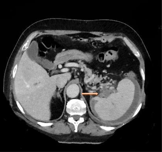 Computed tomography scan of the abdomen with evidence of splenic vein thrombosis at the splenic hilum.
