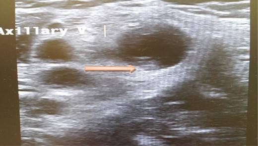 Ultrasound scan of the axillary vein with evidence of thrombus formation.
