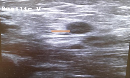 Ultrasound scan of the basilic vein with evidence of thrombus formation.