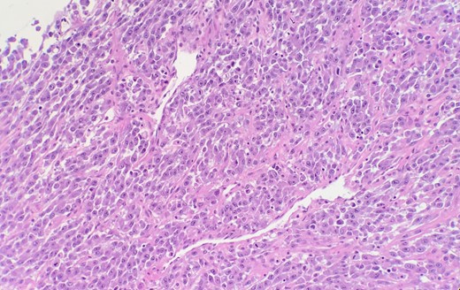 Microscopic examination reveals high grade urothelial carcinoma.