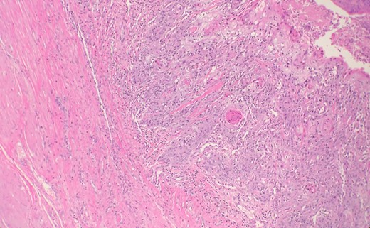 Microscopic examination reveals some areas show squamous differentiation with keratin pearls.