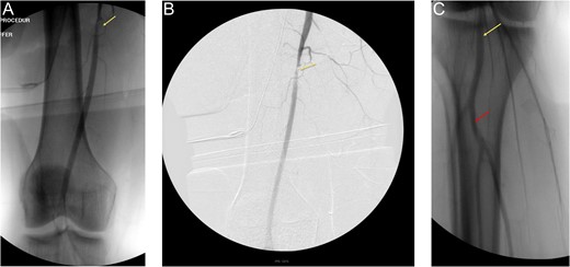 (A) and (B) are on-table angiograms depicting flow through SFA, without any contrast extravasation. (C)— On-table angiogram depicting flow from popliteal artery to trifurcation, without any contrast extravasation.