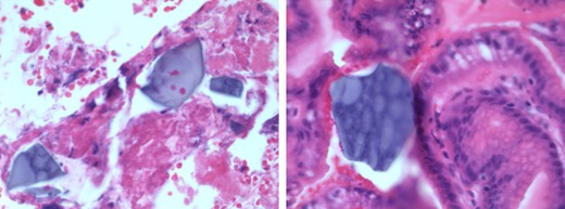 Foci of serositis and fibrinoleukocytic debris with rhomboid, birefringent crystals, suggestive of Kayexalate, in the gastric wall.
