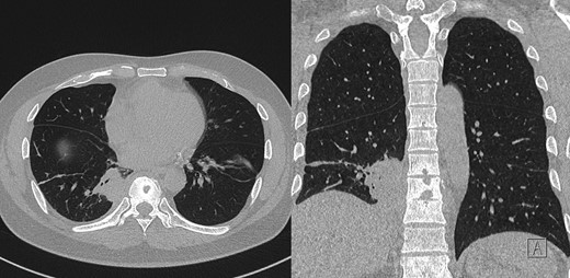 Post-contrast CT chest, showing ostelytic lesion of T9 vertebral body developed since original presentation and imaging. Adjacent to T9 vertebral body is area of persistent parapneumonic effusion.