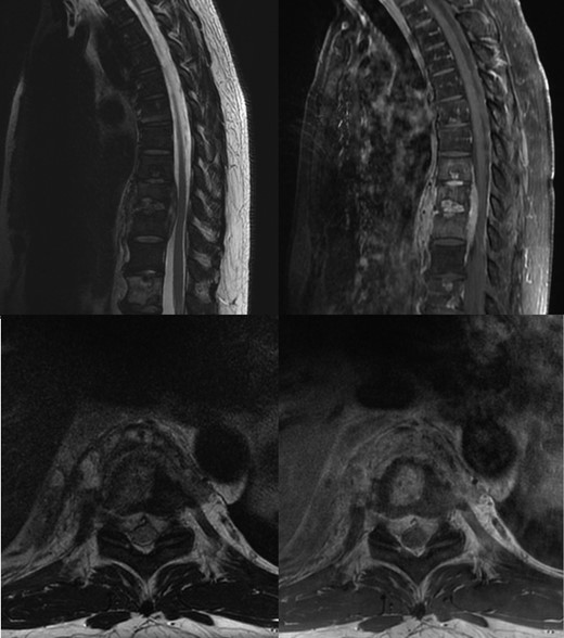 Non-contrast T2 and post contrast T1 MRI, showing T8–T10 spondylodiscitis, prevertebral and epidural phelgmons, without radiological evidence of spinal cord compression.