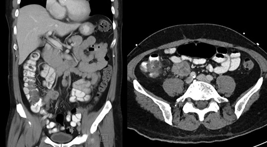 Post-contrast CT abdomen, showing peri-appendicular abscess corresponding to area of increased uptake on gallium scan.