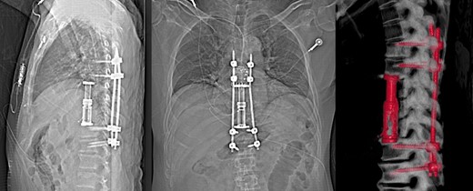 X-ray and 3D reconstruction following non contrast CT thoracic spine, showing final hardware position and spinal alignment after T8–T10 vertebrectomy, reconstruction with expandable cage and percutaneous pedicle screw fixation of T6–T12 (Nuvasive, San Diego, CA).