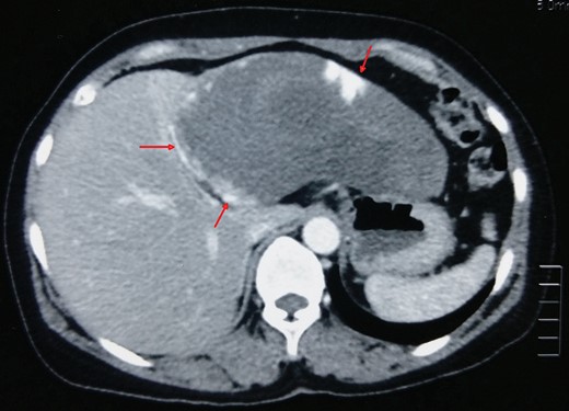A giant hemangioma (15 × 11 cm) with central hypodense areas in left lateral segment of liver (arrow).