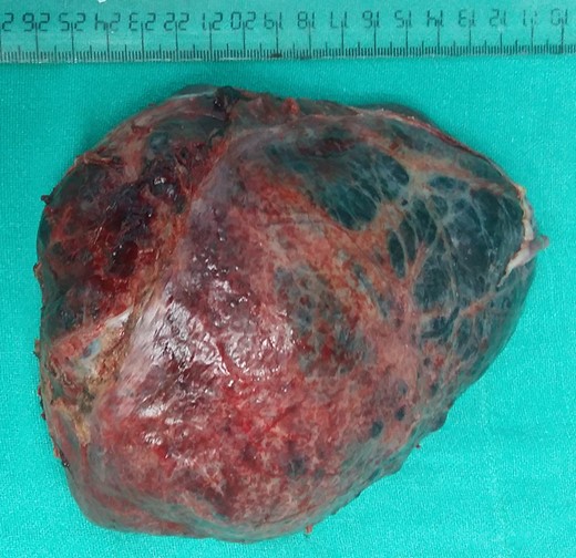 Intraoperative view of well encapsulated liver hemangioma.