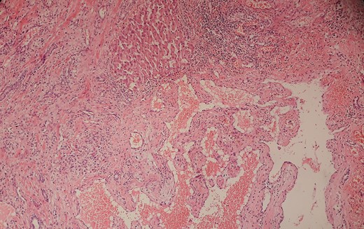 (H&E, ×100) Pathological examination confirmed the diagnosis of cavernous hemangioma.