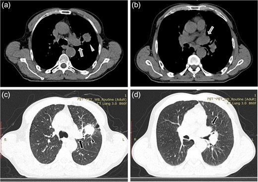 Computed tomopgraphy images showing the solid lesion (triangular pointer) with irregular borders in the left upper lobe (a, c). The tumor infiltrates the upper left pulmonary vein (arrow) which appears dilated and totally occluded due to the presence of the thrombus in its lumen (b, d).