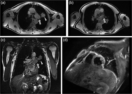 Magnetic resonance tomography images which confirmed the CT findings. (a) Axial plane showing the irregular solid mass in the left upper lobe (triangular pointer). (b and c) Axial and coronal plane showing the dilation and occlusion of the left upper pulmonary vein (arrow). (d) Sagital reconstruction revealing the dilation of the left upper pulmonary vein and the presence of thrombotic material in its lumen (arrow).
