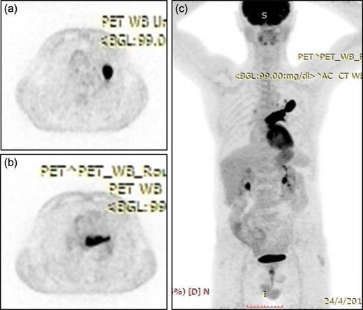 (a) Positron emission tomography scan showing an irregular nodular lesion in the left upper lobe with irregular margins and hypermetabolic activity. (b) Hypermetabolic focus in the lumen of the upper lobe pulmonary vein. (c) Coronar reconstruction showing the focal hypermetabolic activity in the left upper lobe, the left atrium and the left upper pulmonary vein.