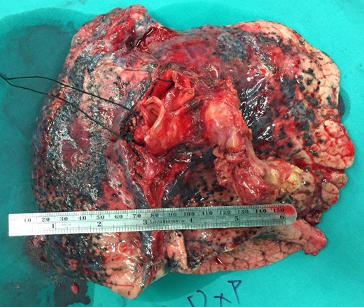 Surgical specimen of the left lung.