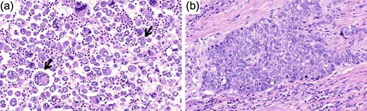 Hematoxylin and eosin image of the tumor (original magnification ×25). (a) Note the emperipolesis in the giant cell component (arrow). (b) The more differentiated component that consisted <5% of the tumor is shown here.