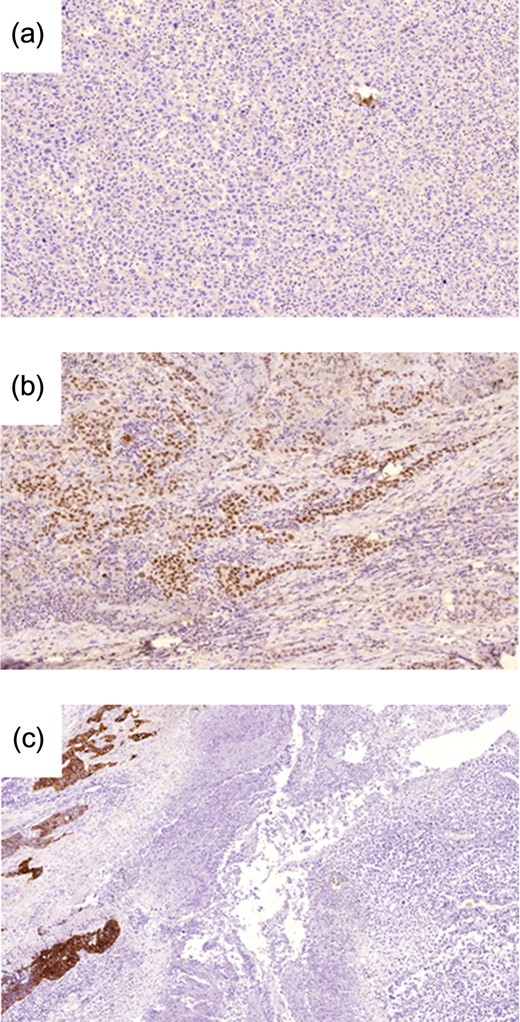 (a) TTF1 expression is negative in the giant cell component (original magnification Ă—10). (b) Positive expression in the adenocarcinoma component (original magnification Ă—10). (c) CK7 expression is noted in the adenocarcinoma component (left) but is negative in the giant cell component (right) (original magnification Ă—5).