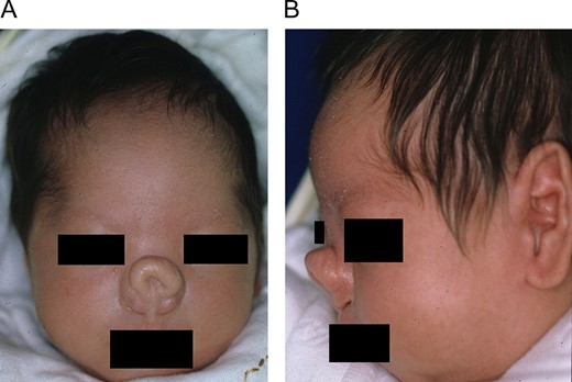 Physical examination revealed a nasal deformity, including a broad nasal root and absence of the nasal tip. (A) Frontal view. (B) Lateral view.