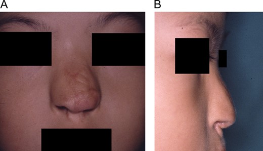 Frontal (A) and lateral (B) views before third operation at 6 years of age for augmentation rhinoplasty.