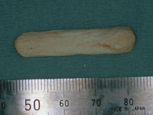 A hydroxyapatite prosthesis was inserted for augmentation rhinoplasty.